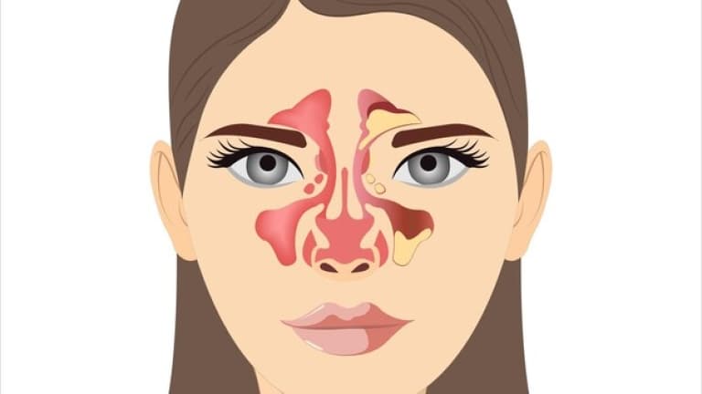 Ostre i Przewlekłe Zapalenie Zatok Przynosowych: Objawy, Metody Leczenia oraz Profilaktyka